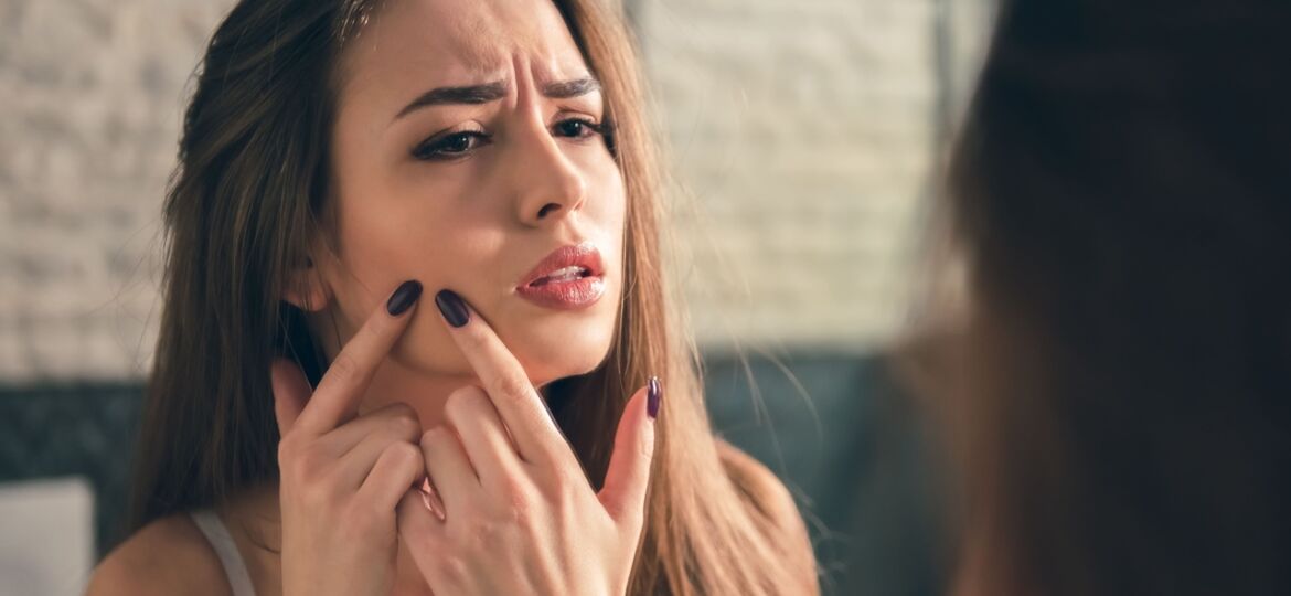 SOP e acne espinhas síndrome do ovário policístico