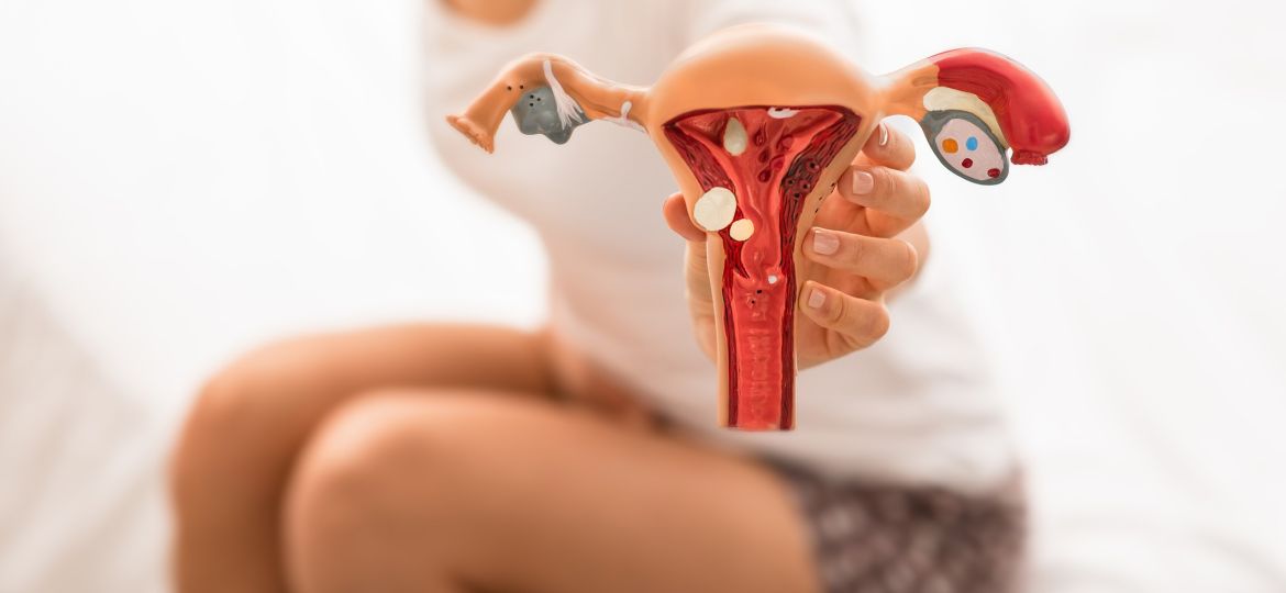 Tratamento para endometriose Papel da alimentação