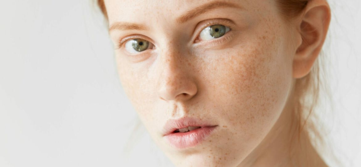 dieta para melasma cardápio